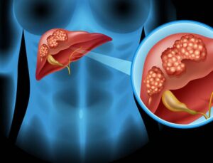 Best Liver Cancer Treatment in Mumbai by Dr. Ganesh Nagarajan