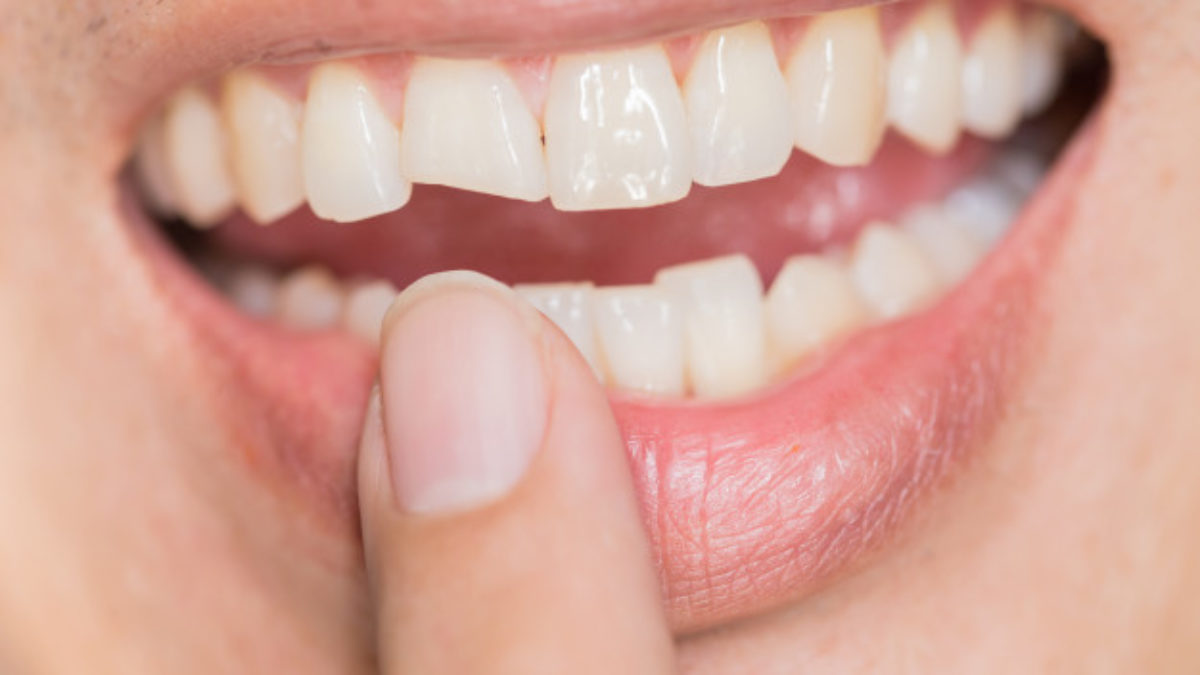 co-Friendly Teeth Whitening Sustainable Ways to Shine
