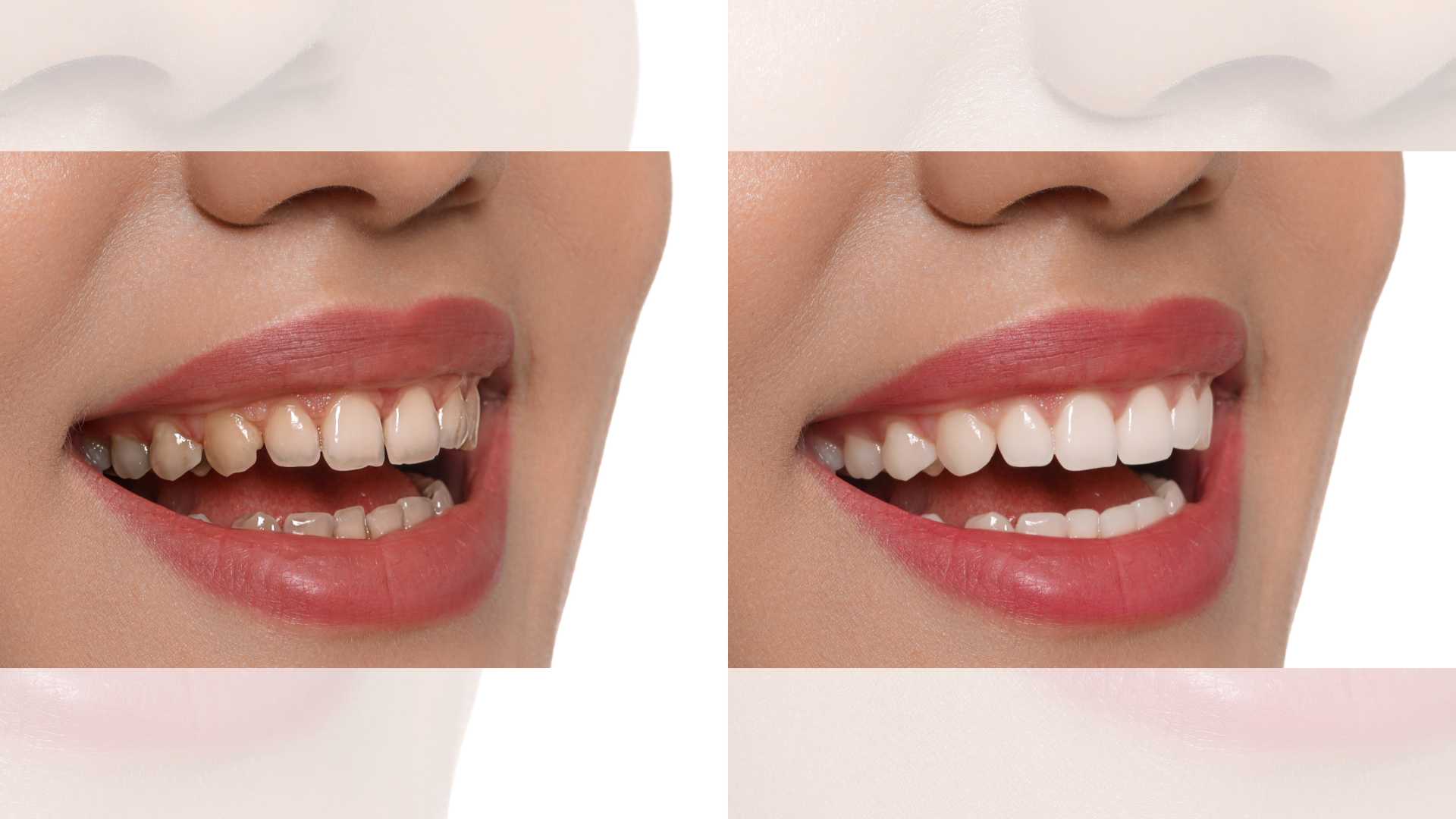 Before And After Dental Implants