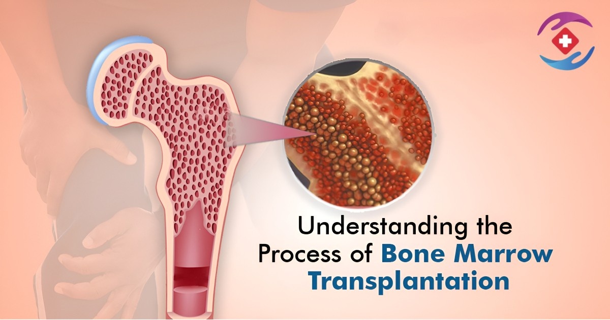 Bone Marrow Transplant In India