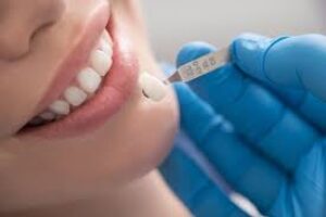 Crooked Teeth? Here’s How Dental Veneers Can Help
