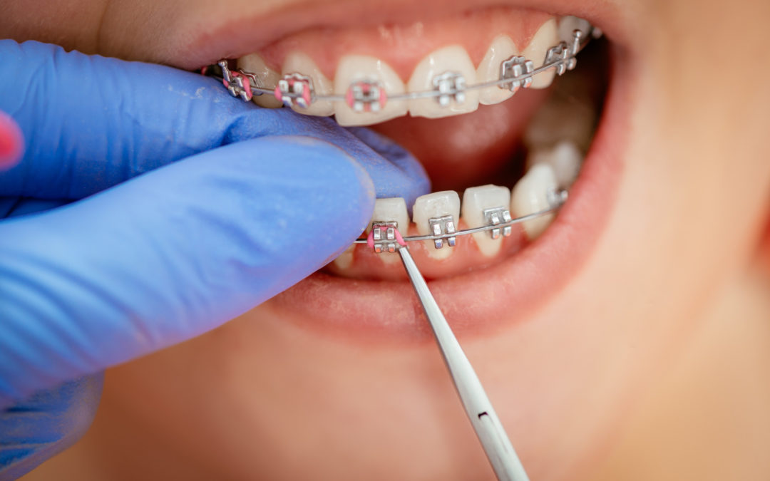 How Braces Help Prevent Long-Term Dental Issues