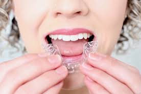 How to Maintain Your Aligners for Long-Term Success