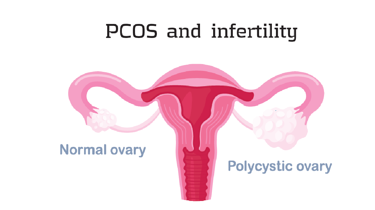 PCOS and Infertility