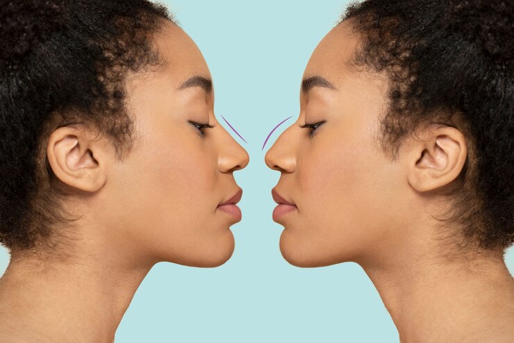 Rhinoplasty surgery