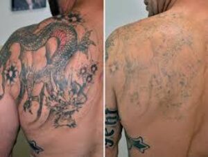 أسرار إزالة الوشم بنجاح في دبي