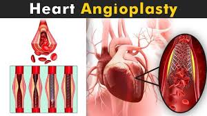 Get Best Angioplasty Surgery In India