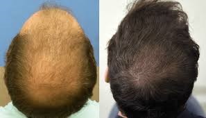 Hair Transplant in Riyadh
