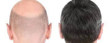 Hair Transplant in Dubai
