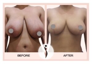 Why Choose Breast Reduction Surgery in Mumbai with Dr. Amiti Shah?