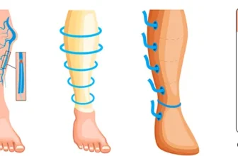 Cost-of-Varicose-Vein-Surgery