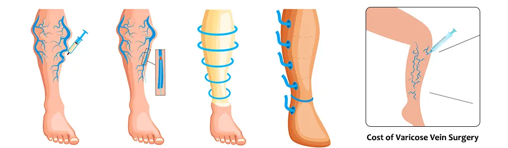 Cost-of-Varicose-Vein-Surgery