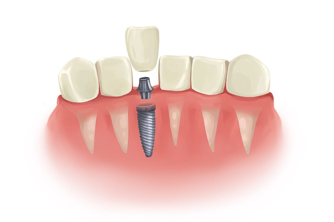 Dental Implants for Seniors A Safe and Effective Solution