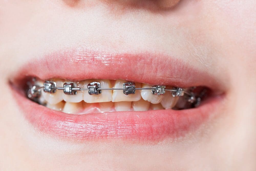 How Dental Braces Can Help with Teeth Alignment and Jaw Problems