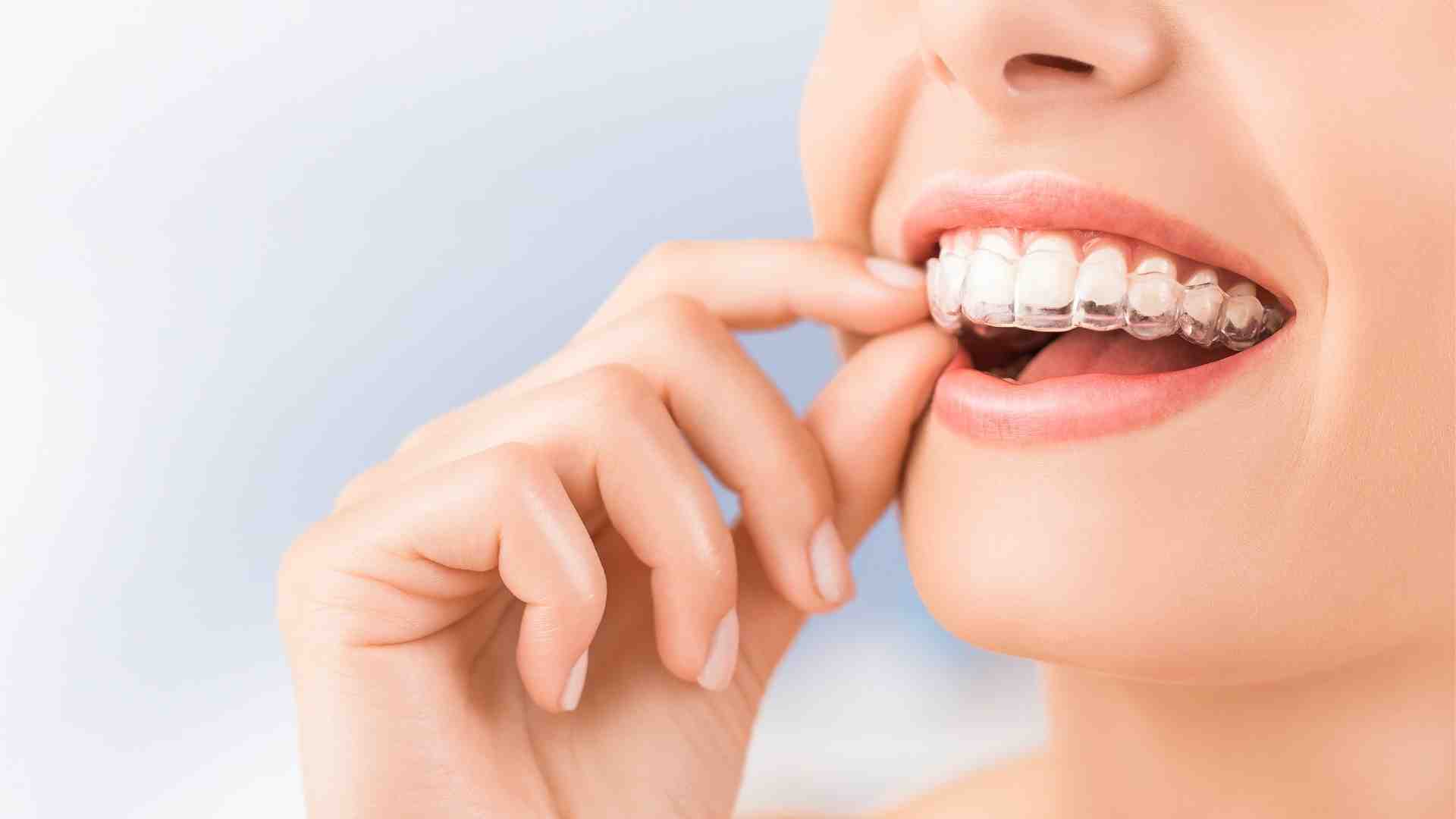 Invisalign for Adults_ A Discreet Way to Fix Your Smile