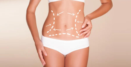 Liposuction in Dubai