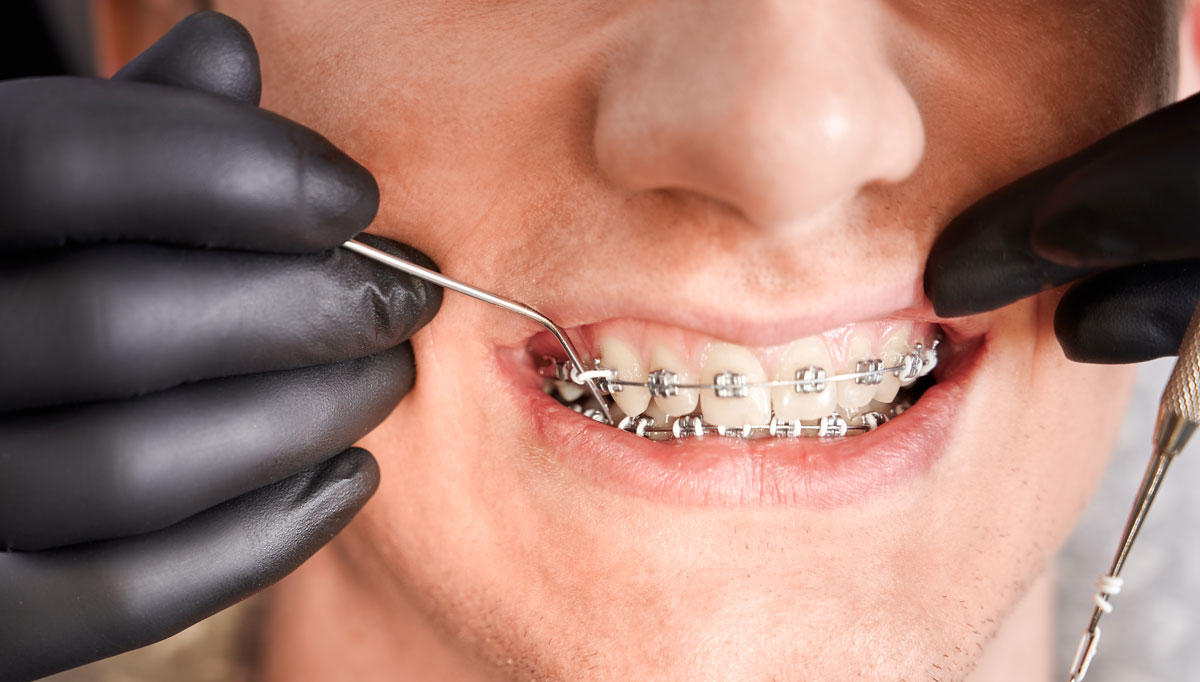Orthodontic Retainers The Final Stage of Your Braces Treatment