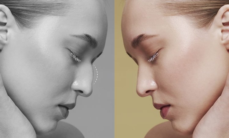 Rhinoplasty Surgery in Dubai