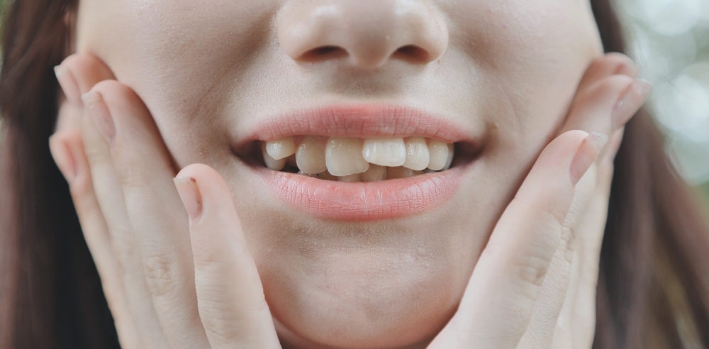 Stop Hiding Your Smile: Overlapping Teeth Treatment and Solutions