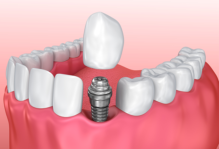 The One-Day Solution for Missing Teeth All About Same-Day Dental Implants