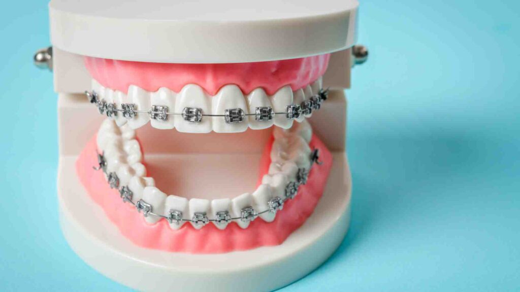 What Are Metal Braces?