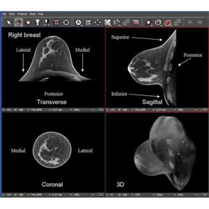 breast cancer lesion detection and diagnostics