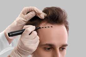hair transplant rajajinagar