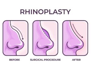 Rhinoplasty Surgery in Navi Mumbai: Redefining Facial Harmony