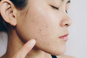 Natural vs. Medical Acne Scar Treatments in Dubai: Which One is Right for You