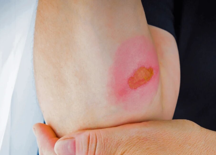 Bed-Sores-Treatment-in-Mumbai