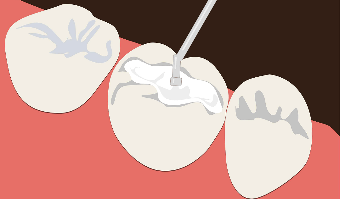 How Composite Fillings Can Save Your Teeth Without Sacrificing Aesthetics