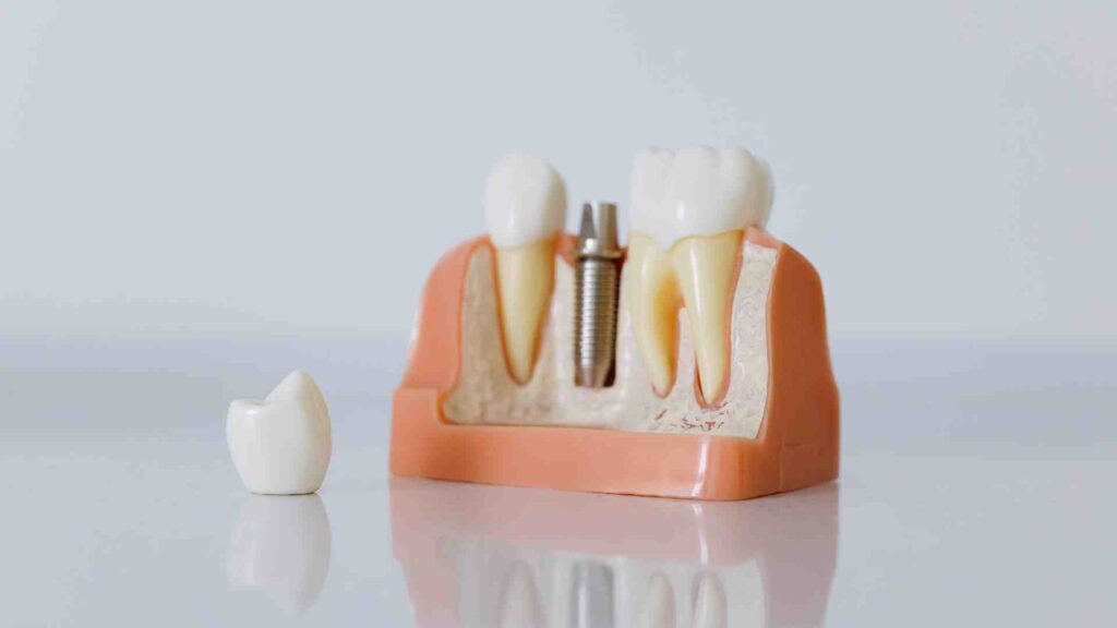 How Dental Implants Improve Oral Health