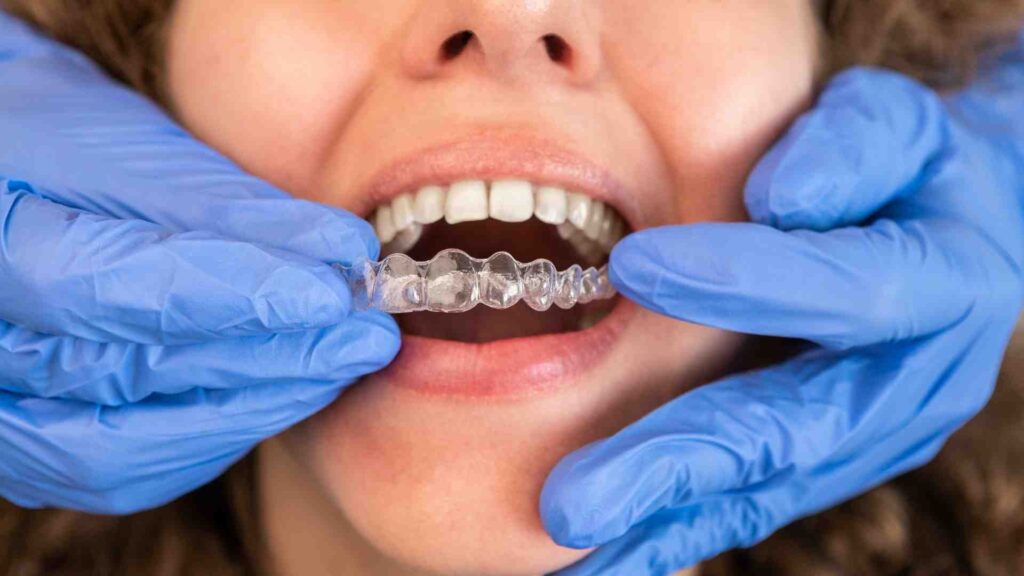 How Does Invisalign Work?