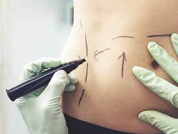 Liposuction in Dubai