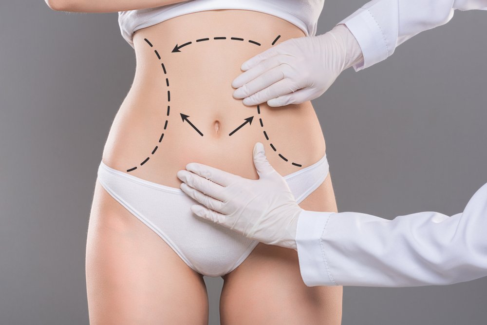 Liposuction Riyadh