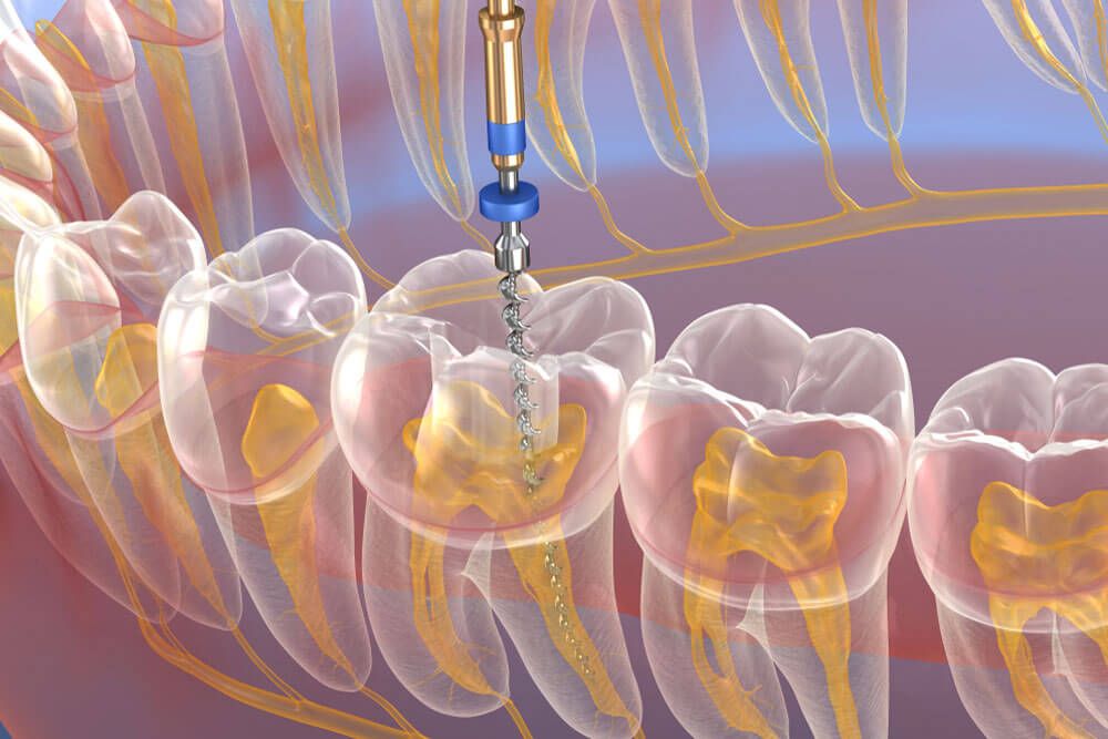 Root Canal vs. Dental Implants Which Option Is Best for You