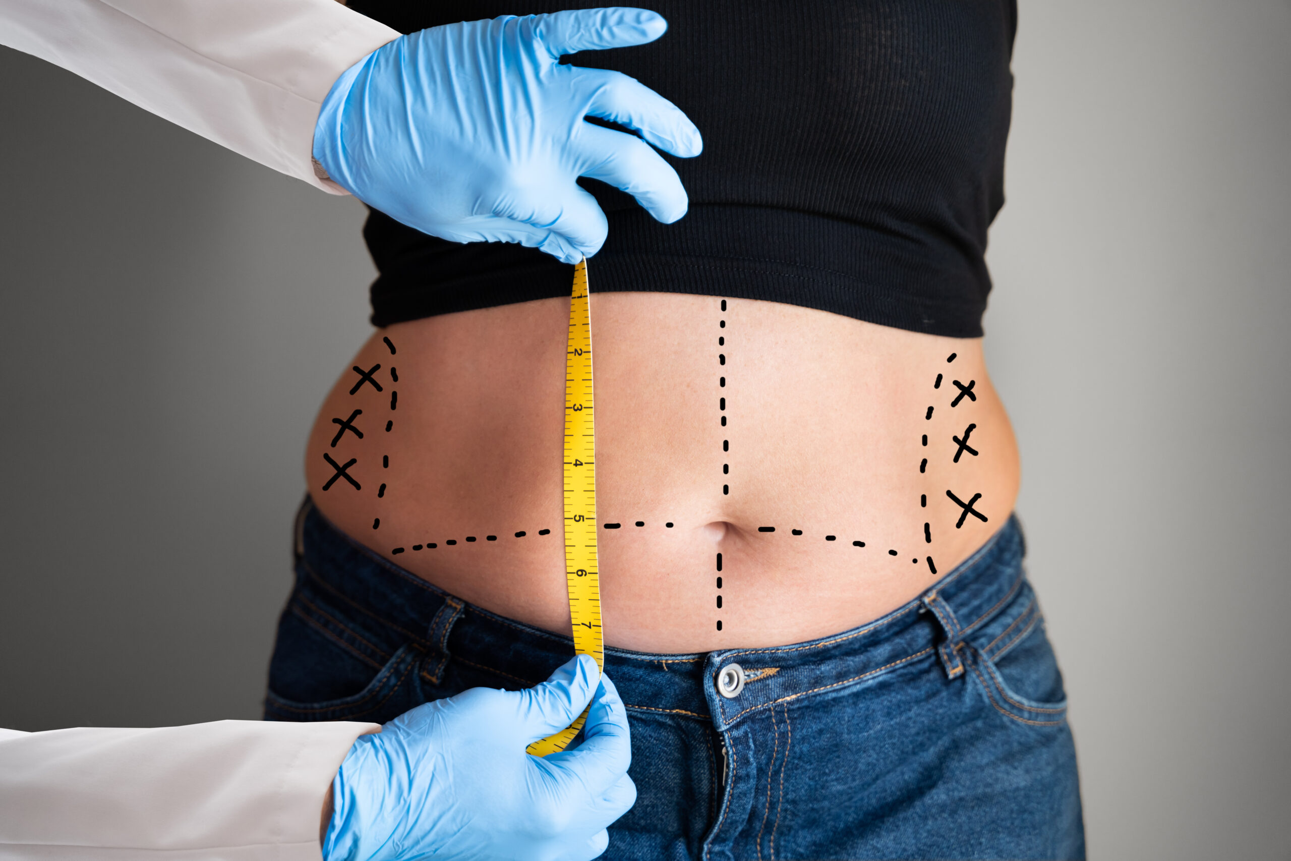 Tummy Tuck in Dubai