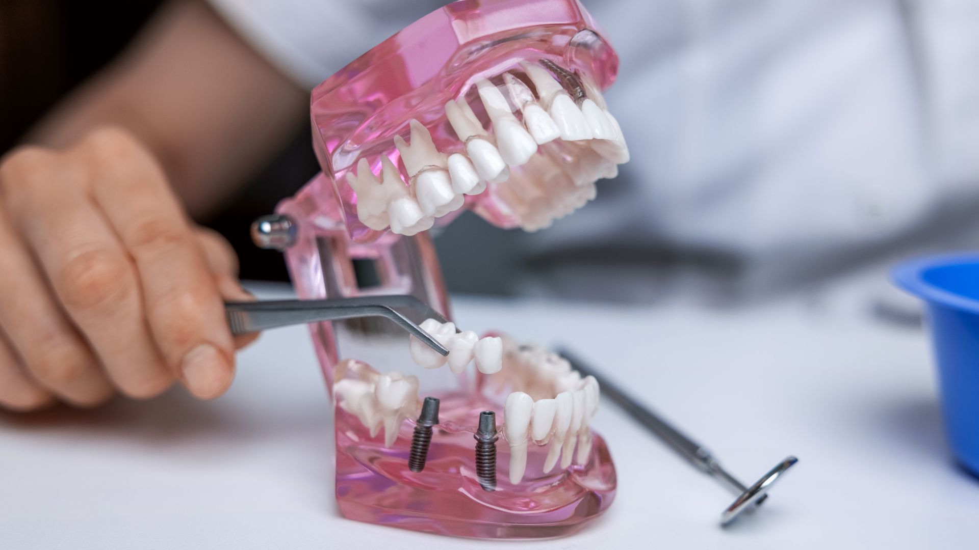L'avenir de la dentisterie : explorer l'impact des modèles 3D