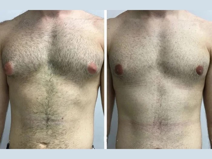 Best Gynecomastia Surgeons in Dubai