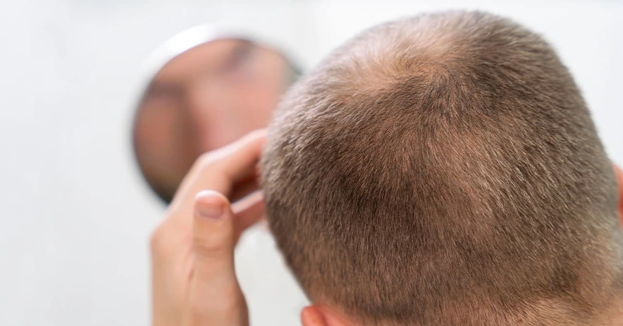 Affordable Hair Transplant Options