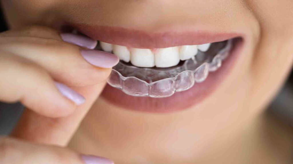 Comment les aligneurs transparents redressent-ils les dents ?