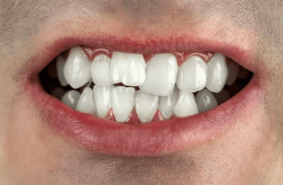 Crooked Teeth Treatment Myths Separating Fact from Fiction
