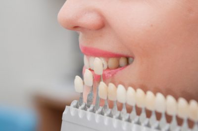 Dental Veneers Cost Dubai
