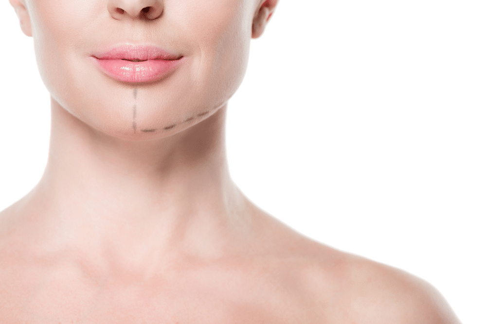 How a Vector Facelift Can Enhance Your Natural Beauty