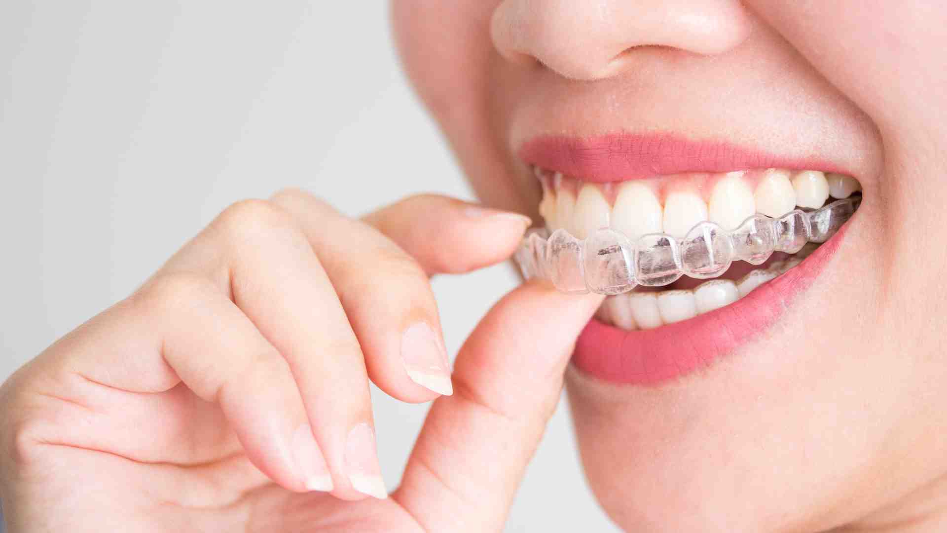 Invisalign Genève - Aligneurs transparents pour un sourire amélioré