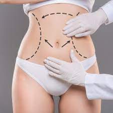 Liposuction in Dubai
