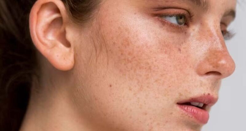 Melasma Treatment in Dubai