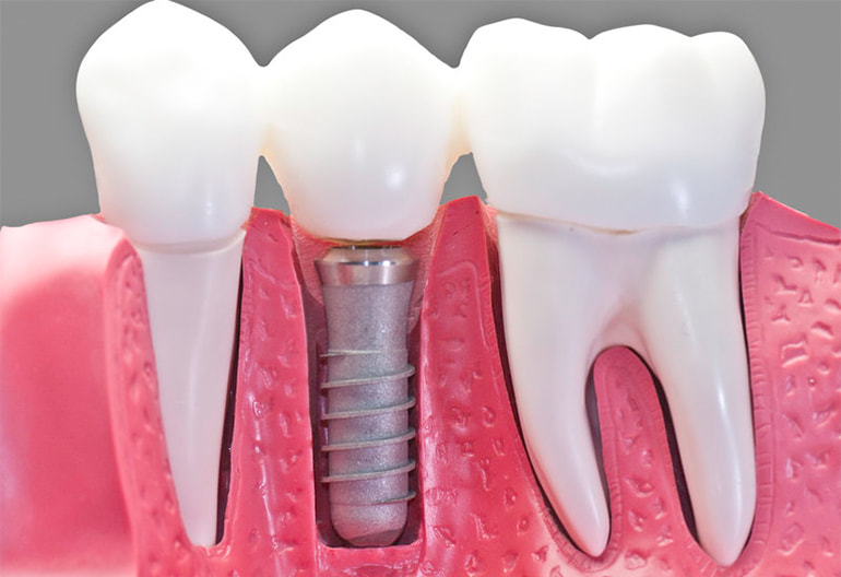 Expert dentists in Anna Nagar, Chennai – High-quality dental care at Vijaya Dental Care, including teeth cleaning, implants, and braces.
