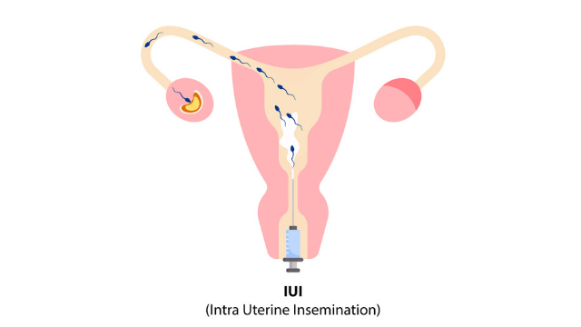 iui treatment