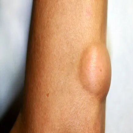 Lipoma Removal Surgery in Navi Mumbai – Dr. Sanket Ekhande